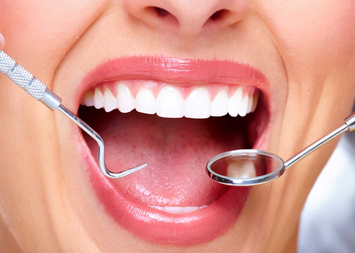5 Things You Can Do To Protect Your Dental Veneers
